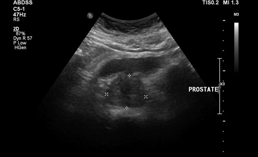 Ultrazvuková prostatitída pred užívaním Urosaf