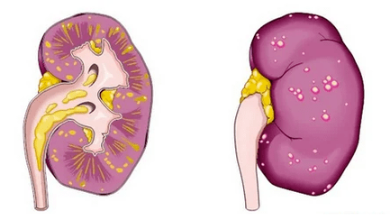 Čo je akútna prostatitída, vedie k