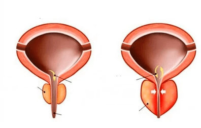 Čo je akútna prostatitída